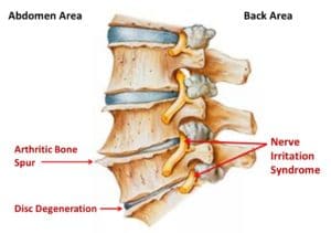 osteoarthritis spinal degenerative disc disease joint sciatica pain djd ddd between lumbar bone stenosis joints chiropractic spurs differences causes