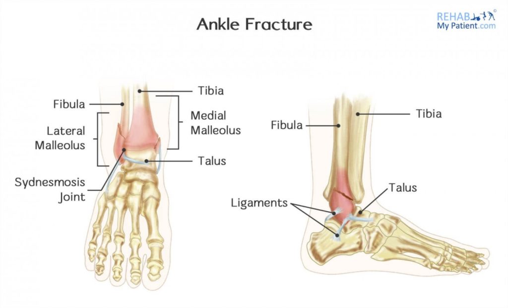 ankle-sprain-vs-fracture-treatment-cawley-physical-therapy