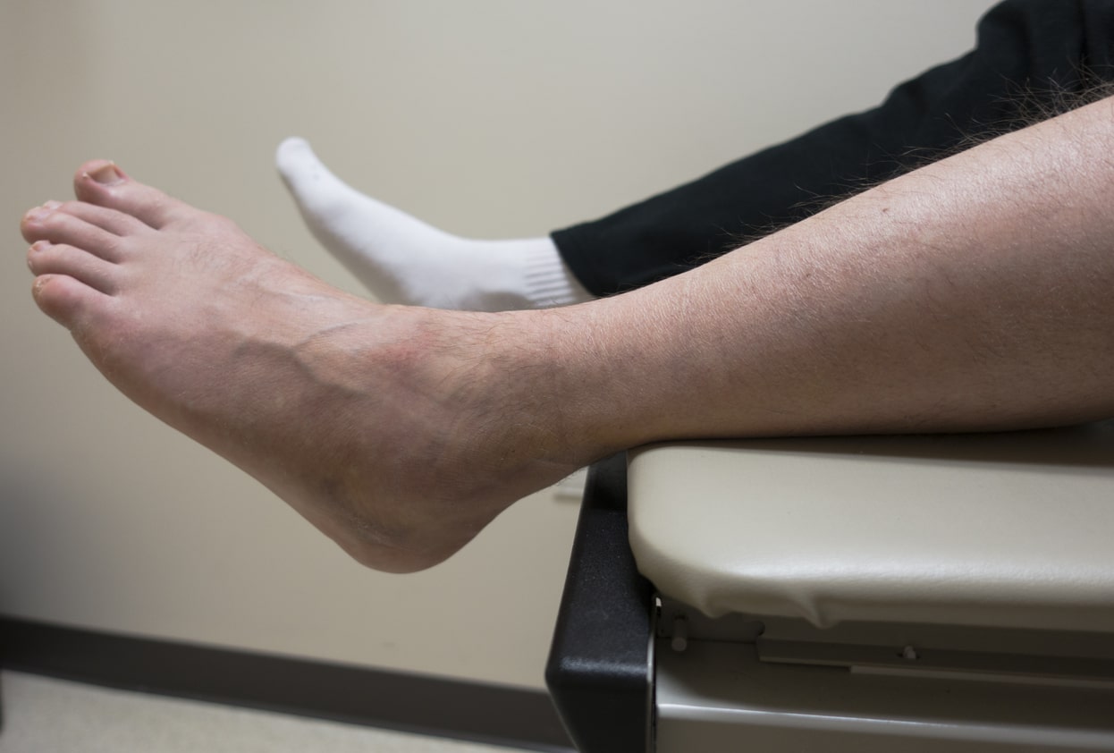 swollen ankle and heel pain