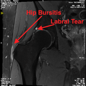 1.-Trochanteric-Bursitis-and-Hip-Cartilage-Tear-on-MRI - Cawley ...