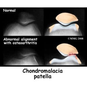 Chondromalacia Physical Therapy | Cawley Physical Therapy